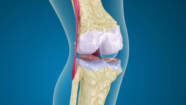 Osteoporosis of the knee joint.