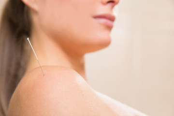 Acupuncture needle pricking on woman shoulder