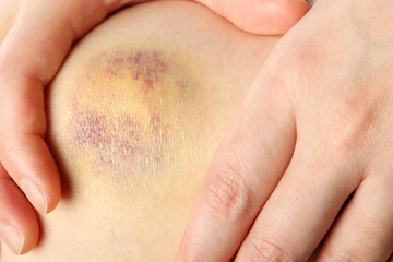 Fototapeta premium Bruised knee of a woman