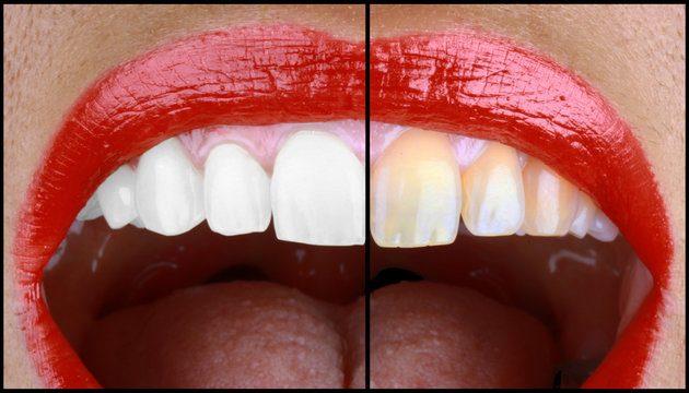 Blanchiment des dents...