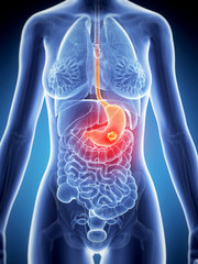 3d rendered illustration of stomach cancer - obrazy, fototapety, plakaty