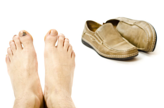 Pies castigados con hematomas y callos