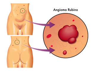 angioma rubino