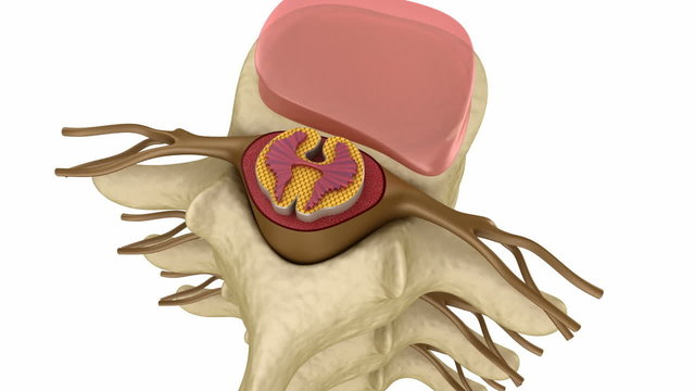 Prolapse of intervertebral disc
