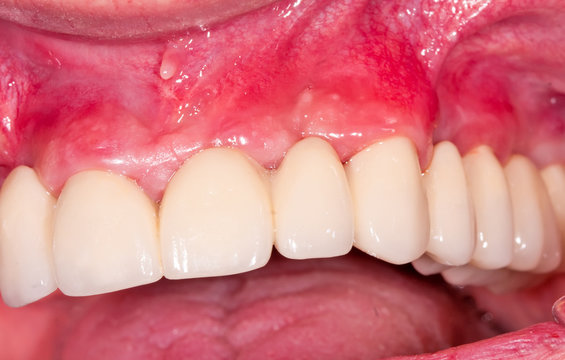 Dental bridge