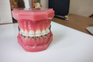 Dental braces model