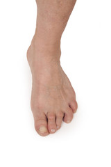 Old Woman's Foot Deformed From Rheumatoid Arthritis