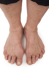 Old Woman's Foots Deformed From Rheumatoid Arthritis