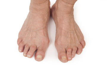 Old Woman's Foots Deformed From Rheumatoid Arthritis