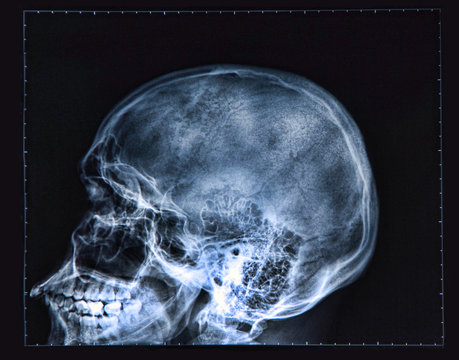 X-ray of human Head