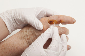 Injured Hand