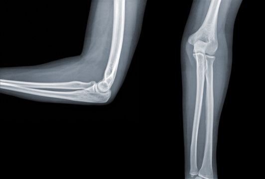 Elbow Xray Images – Browse 8,703 Stock Photos, Vectors, and Video | Adobe  Stock