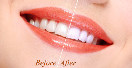 Woman smiling with teeth close-up