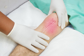 Hands of physiotherapist treatment  the knee joint