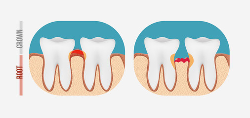 Periodontal tooth disease