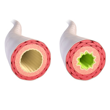 Bronchien - gesund und entz&uuml;ndet / 3D Illustration