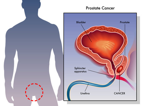 cancro della prostata