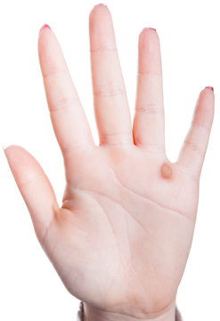 Warze an einer Hand