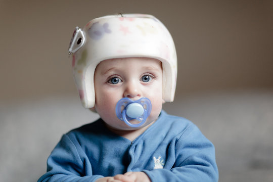 Baby With Helment For  Plagiocephaly