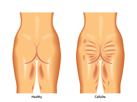 cellulite
