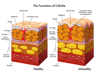 formazione della cellulite - obrazy, fototapety, plakaty
