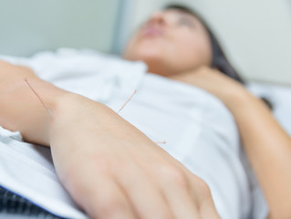 Acupuncture patient with needles along arm