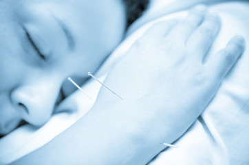 Acupuncture patient with needles along arm