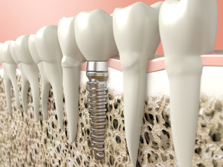 Dental implant - 52499016