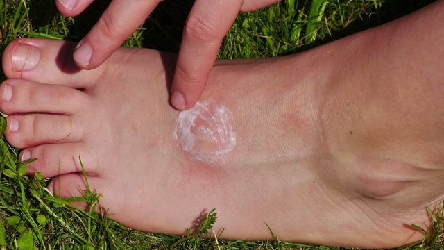 Lubrication of the foot after insect bite.