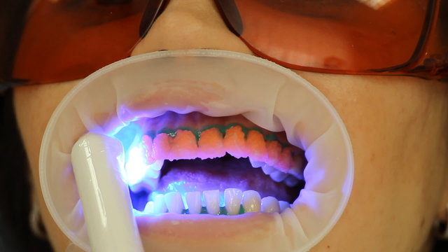 Teeth Whitening. Activation of the gel polymerization light. 