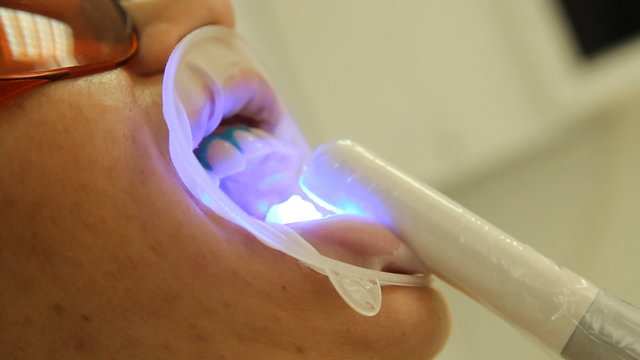 Teeth Whitening. Activation of the gel polymerization light. 