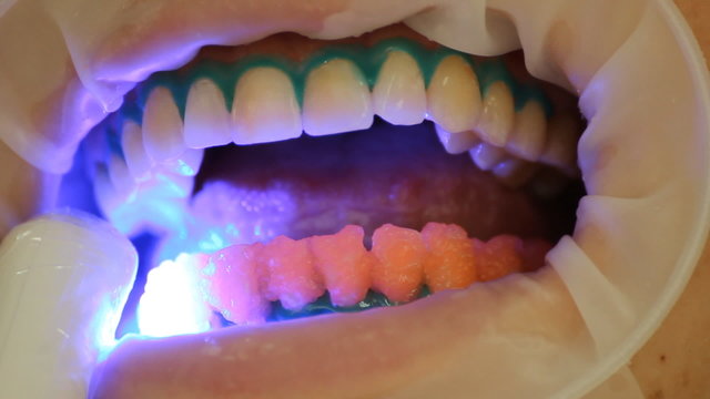 Teeth Whitening. Activation of the gel polymerization light. 