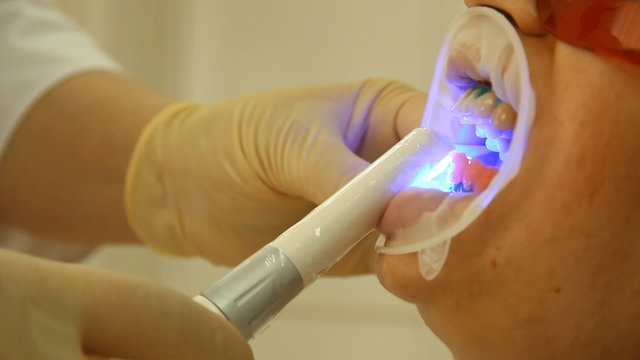 Teeth Whitening. Activation of the gel polymerization light. 