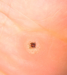 Black spotted callus under a human foot