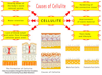 Formation of Cellulite - obrazy, fototapety, plakaty