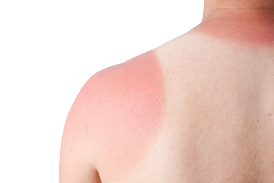 sonnenbrand