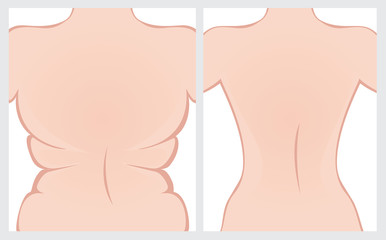 Fat back before and after treatment. Vector illustration.