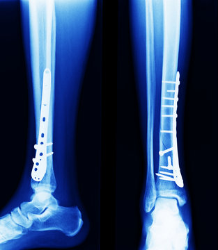 x ray of fractures bone