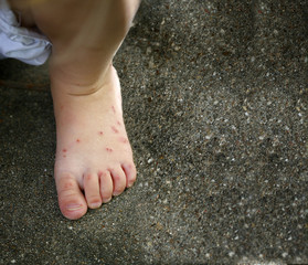 Child's feet with ant/ mosquito bites allergy