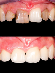 Dental restoration