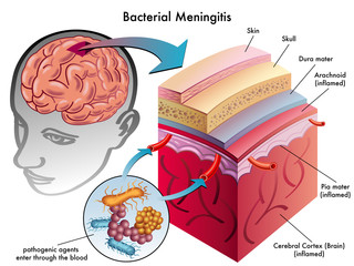 meningite batterica