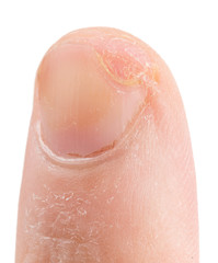 Fototapeta premium Finger cut with knife, three weeks after unjury, isolated