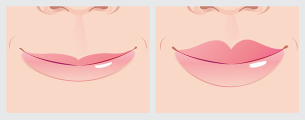 Lips correction creating beautiful smile line