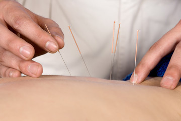 Physiotherapist doing accupuncture - 53862099