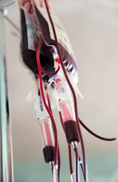 Bluttransfusionen in Plastikbeuteln h&auml;ngen an einem Tropfhalter- Szene im Krankenhaus