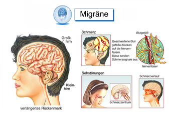 Migräne.Kopfschmerzen
