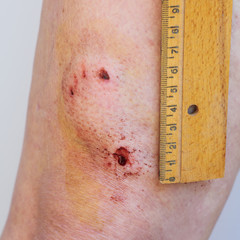 Accident, dog bite, puncture wound on human leg