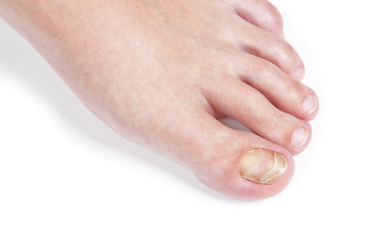 Skin fungus on the nail, on the female foot. Close-up.