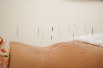 Acupuncture Needles in a Woman's Midsection