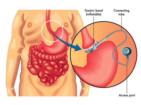 bendaggio gastrico regolabile